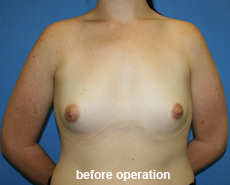 plastic-surgery-breast-augmentation